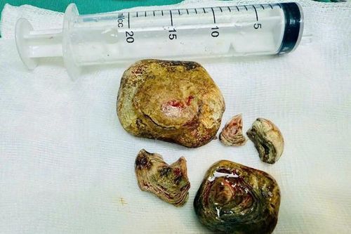 Phẫu thuật khối sỏi bàng quang kích thước lớn cho bệnh nhân mắc nhiều bệnh lý nền