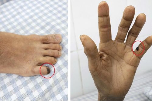 Vết xước do gà đạp khiến người phụ nữ 60 tuổi suýt mất mạng