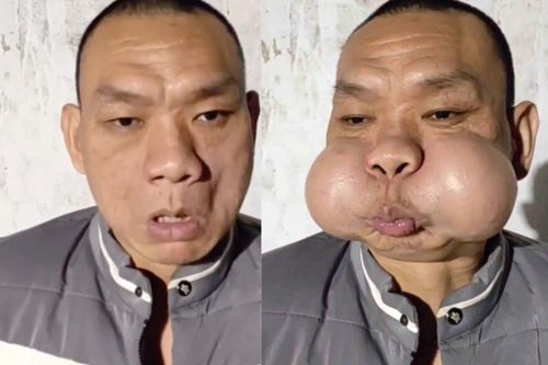 Gương mặt biến dạng của 'hoàng tử ếch' TQ thổi thủy tinh suốt 30 năm