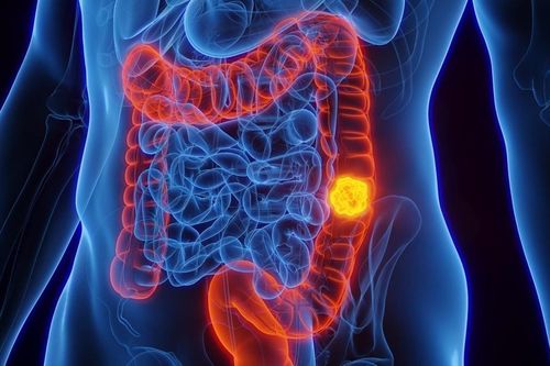 4 dấu hiệu cảnh báo của ung thư đại trực tràng