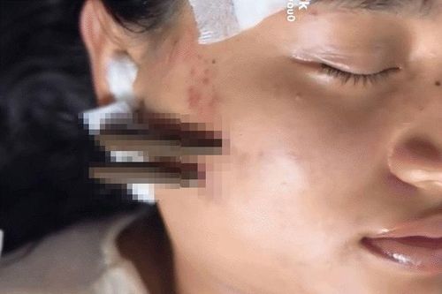 Clip đỉa 'hút độc' gây kinh hãi MXH: Bác sĩ lên tiếng