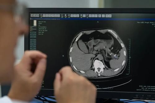 Trung Quốc: công cụ AI giúp phát hiện sớm ung thư tụy