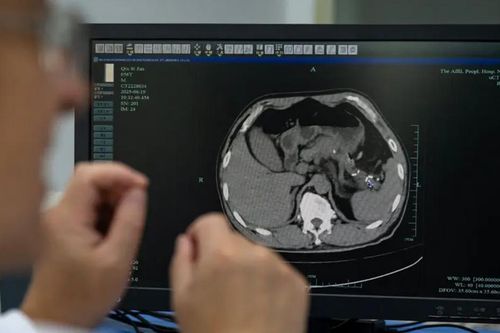 AI đang phát hiện những khối u nguy hiểm mà các bác sĩ có thể bỏ sót