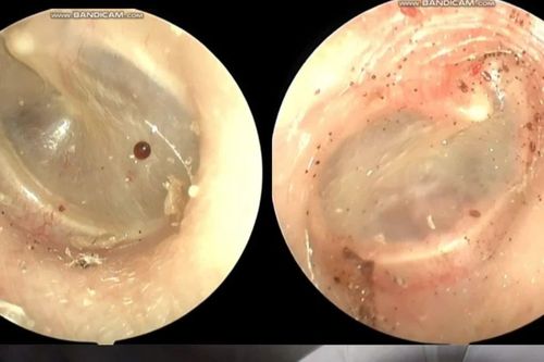 Phát hiện bọ chó sống trong tai người phụ nữ 60 tuổi
