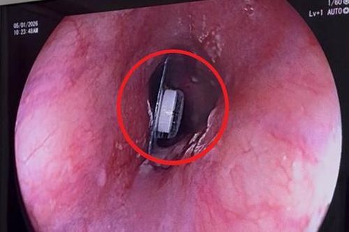 Người phụ nữ 60 tuổi đau ngực thốc ngược lên, bác sĩ phát hiện bí mật 'đáng sợ' bên trong