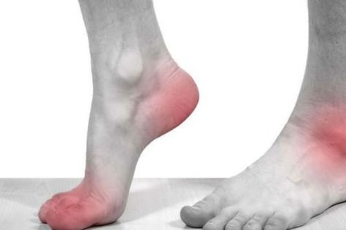 Khớp ngón tay, chân nam thanh niên biến dạng vì bệnh gout