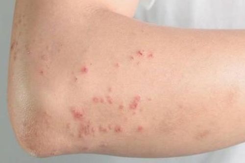Nhiều trường hợp ở Khánh Hòa bị giun đũa chó mèo, người dân chủ động phòng bệnh
