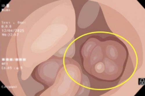 Người đàn ông có 3 dấu hiệu của bệnh ung thư nhưng không biết