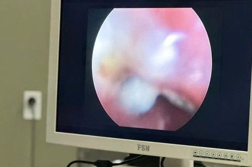 Cà Mau: Cứu sống 2 bệnh nhi nuốt dị vật nguy hiểm