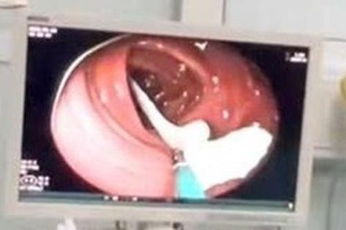Người đàn ông 35 tuổi sốc nặng khi thấy ký sinh trùng 'khổng lồ' đang sống trong ruột