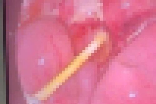 Bé 5 tuổi đau bụng kéo dài, gia đình sốc nặng khi bác sĩ gắp ra thứ 'đáng sợ' trong bụng bé