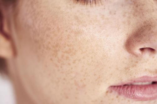 Nguyên nhân sâu xa của việc da bị nám và tàn nhang