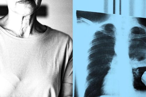 Vì sao ung thư có thể tái phát sau nhiều năm - và cách ngăn chặn từ gốc