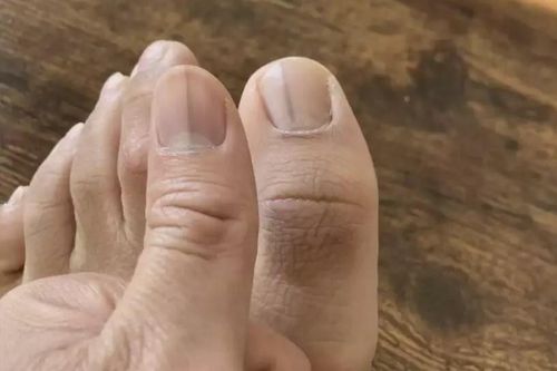 Dấu hiệu lạ trên móng chỉ báo mắc ung thư nguy hiểm