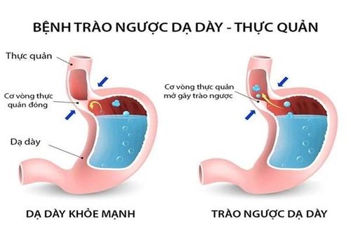 Thay đổi chế độ ăn uống chữa trào ngược dạ dày – thực quản