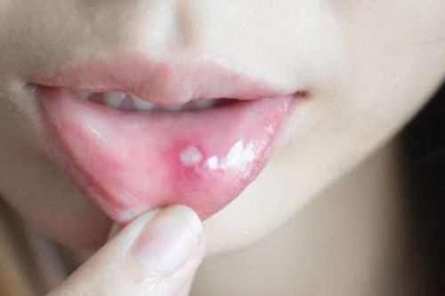 Đi khám càng sớm càng tốt nếu thấy vết loét này trong miệng
