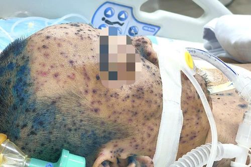 Lây thủy đậu từ con, bố 36 tuổi nguy kịch vì biến chứng nặng