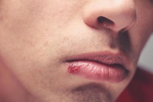 Chủ quan vết loét nhỏ ở miệng, người đàn ông mắc ung thư sau một năm