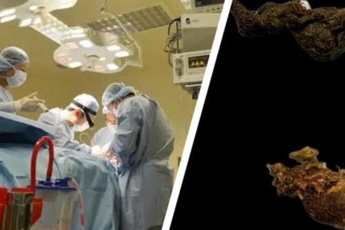 TP.HCM: Bé gái 9 tuổi bị tắc ruột do thói quen 'ăn tóc'