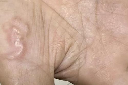 Thường xuyên ăn món 'vạn người mê', cô gái trẻ sốc khi biết nhiễm 4 loại ký sinh trùng