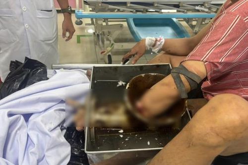 Nguy cơ tiềm ẩn và hậu quả khó lường từ máy xay thịt