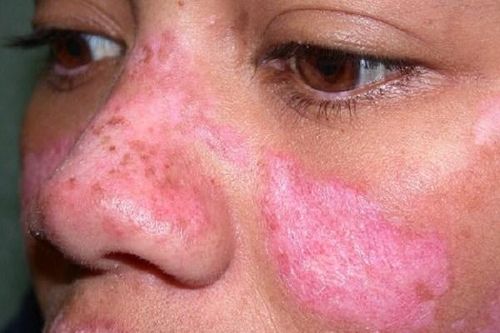 Cô gái Huế đột ngột qua đời trước ngày cưới nửa tháng do mắc bệnh lupus ban đỏ: Cảnh báo 1 nhóm phụ nữ nguy cơ cao mắc bệnh