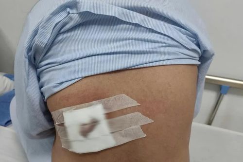 Hoại tử vùng lưng do tự chữa mụn nhọt bằng đắp lá
