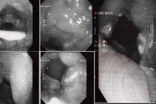 Viêm amidan cấp mủ có thể gây nhiều biến chứng nguy hiểm