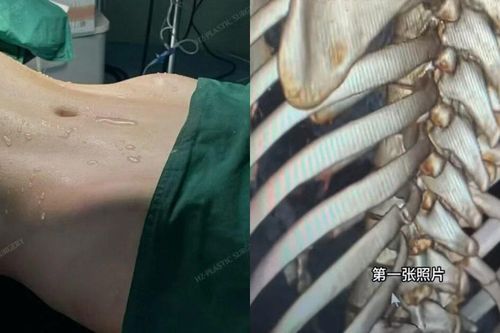 Xu hướng bẻ xương sườn để có vòng eo con kiến