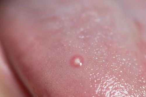 Dấu hiệu bệnh nguy hiểm biểu hiện ngay ở lưỡi