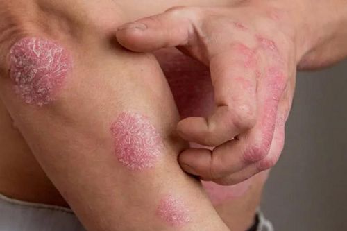 Cảnh giác các bệnh da thường gặp trong mùa lạnh