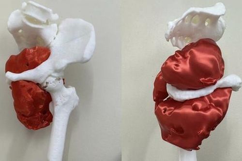 Cứu sống bệnh nhân ung thư hiếm gặp bằng phẫu thuật tháo nửa khung chậu