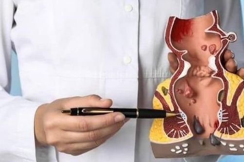 Trĩ nội độ 2 có cần mổ không?