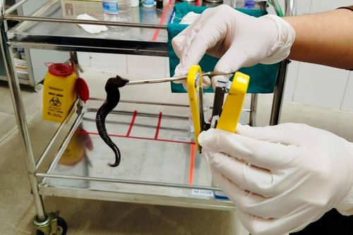 Bác sĩ gắp dị vật khó tin từ hốc mũi người bệnh