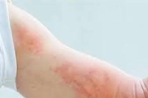 Bệnh giun sán gia tăng tại Khánh Hòa, hơn 290 ca dương tính trong 2 tuần