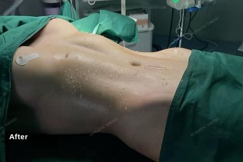Bẻ xương sườn để có vòng eo con kiến