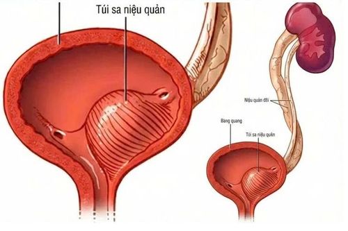 Sốt cao liên tục, trẻ 6 tháng tuổi nhiễn trùng tiểu nặng