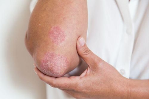 Nhận biết các biểu hiện tổn thương viêm khớp vảy nến