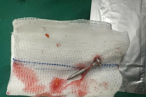 Nam thanh niên bị đinh bắn thủng ruột non trong khi lao động