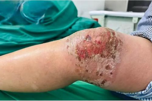 Viêm da, nhiễm trùng nặng do tự đắp thuốc nam, thuốc lá để điều trị đau khớp