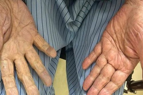 Hút nhiều cục máu đông cứu cụ ông 97 tuổi khỏi nguy cơ cắt cụt tay