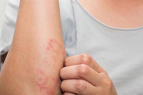 Đề phòng những bệnh về da trong mùa lạnh