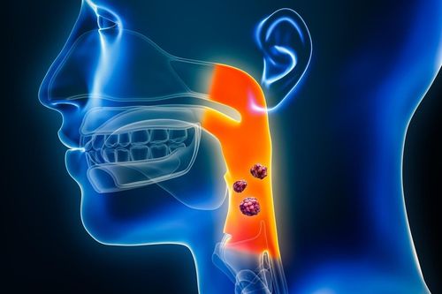 Triệu chứng ung thư vòm họng giai đoạn đầu