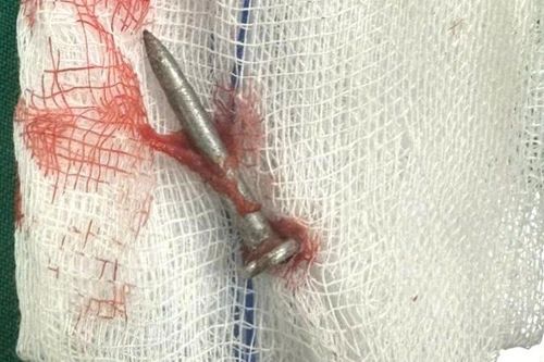 Quảng Trị: Cứu thanh niên bị đinh xuyên thủng ruột non