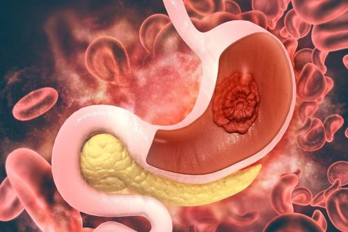 Ung thư dạ dày nguy hiểm và diễn biến nhanh: Ai có nguy cơ mắc?