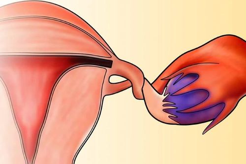 Xoắn phần phụ, cấp cứu phụ khoa nguy hiểm cần phát hiện sớm
