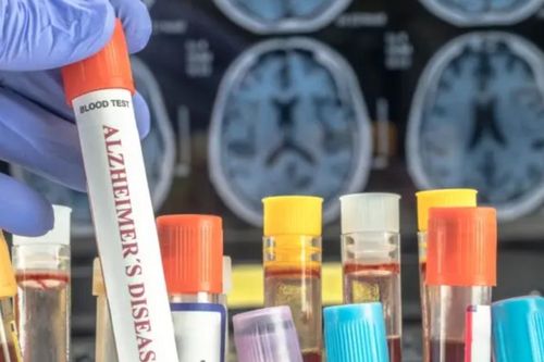 Sàng lọc Alzheimer sớm hơn, rẻ hơn nhờ công nghệ mới
