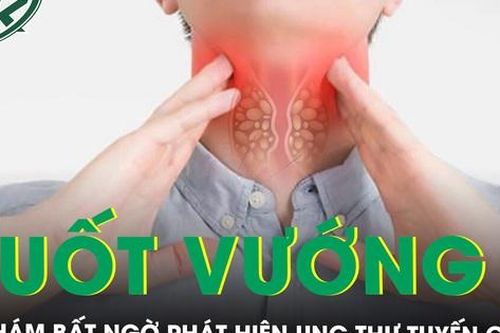 Nuốt vướng, mệt mỏi đi khám bất ngờ phát hiện ung thư tuyến giáp