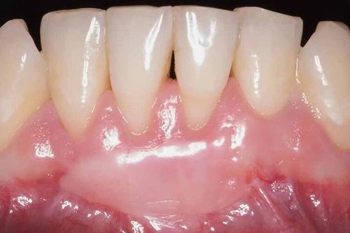 Những điều nên và không nên sau ghép lợi