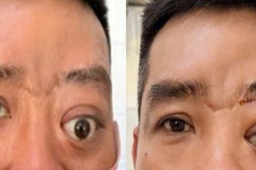 Bệnh hiếm gây lồi mắt, 20 năm Bệnh viện Tai Mũi Họng TPHCM chỉ gặp 2 ca